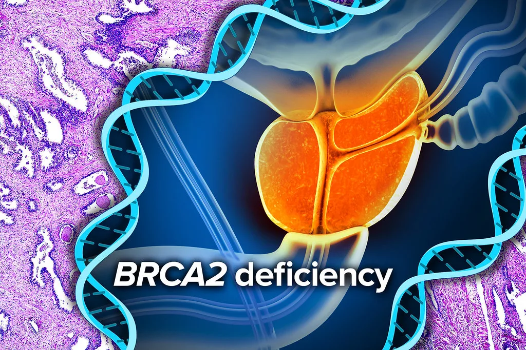 Prostate Cancer: BRCA2 deficiency
